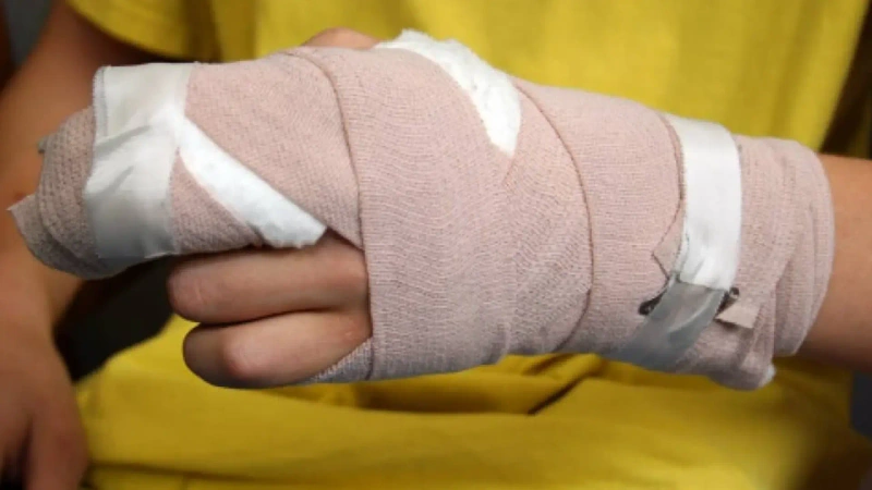 Persona lesionada (detalle en la foto), por quemar pólvora en la época decembrina.