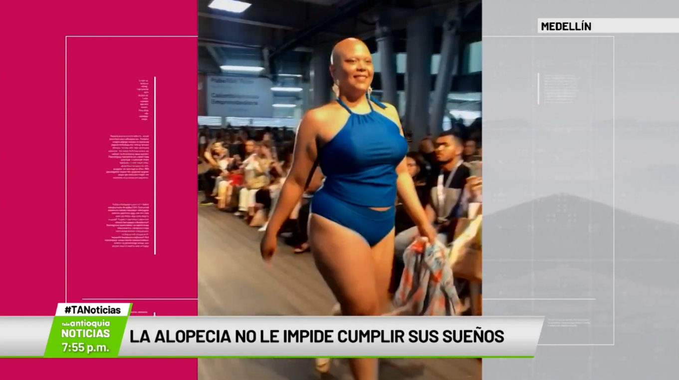 La alopecia no le impide cumplir sus sueños