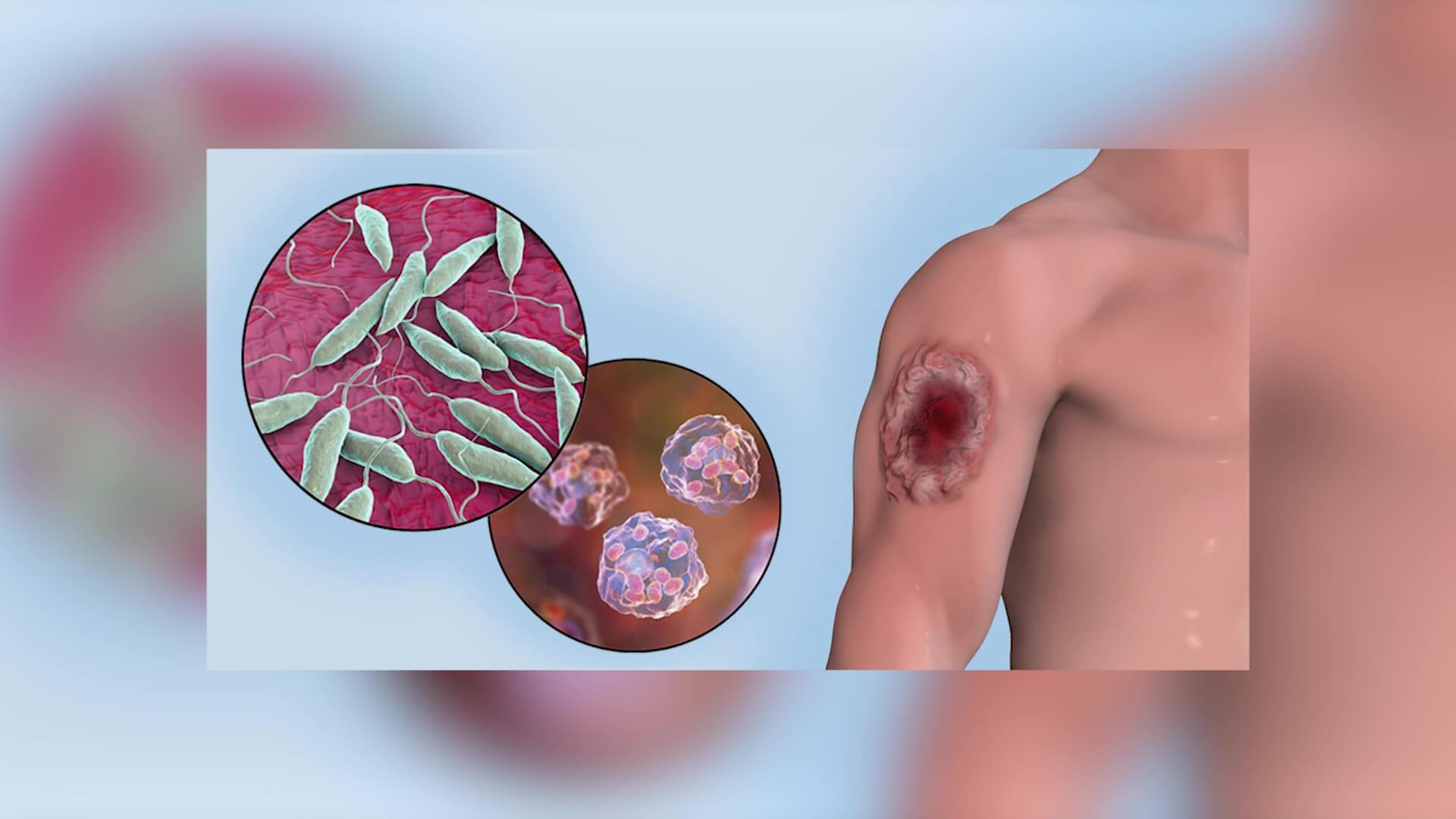 Aprobada patente para crema contra la leishmaniasis