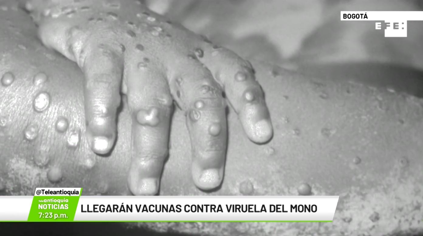 Llegarán vacunas contra viruela del mono