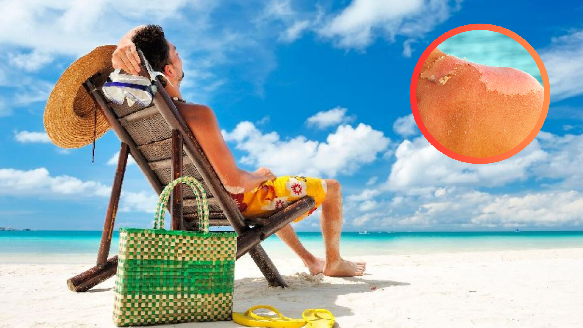 Vacaciones al sol: cómo proteger tu piel y evitar daños